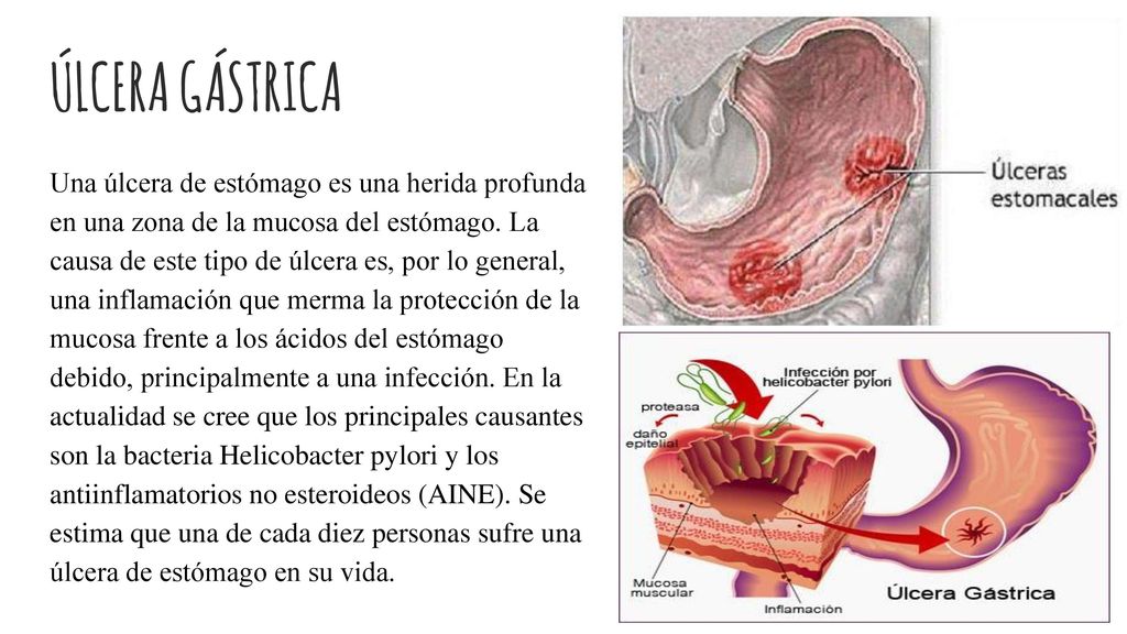 Como se forma una ulcera gastrica